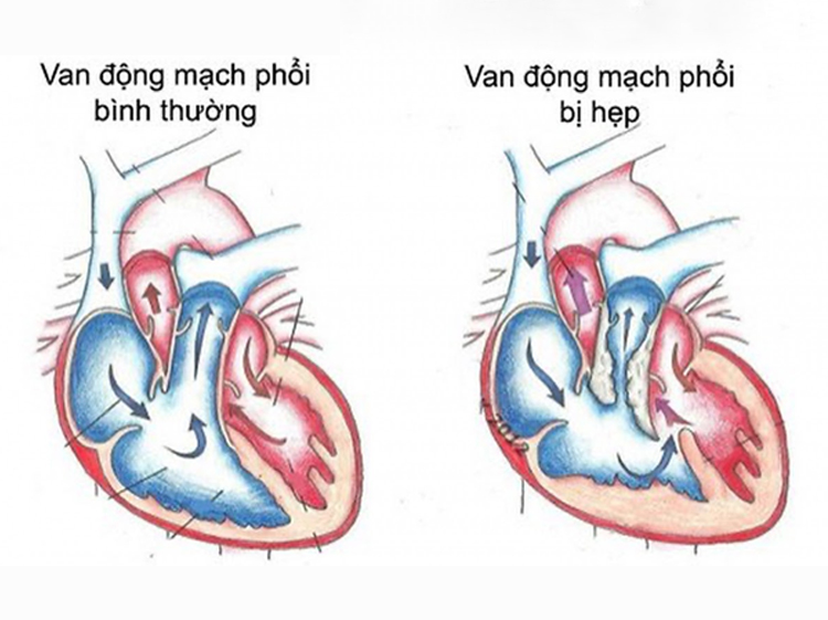 Hẹp van động mạch phổi khiến dòng chảy của máu từ tim đến phổi bị cản trở